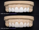 Veneers